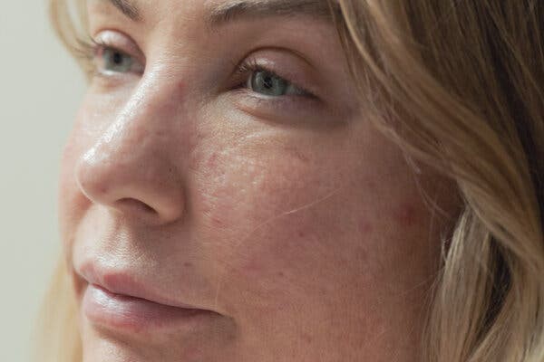 Ms. Redzikowski has not stopped picking and doubts she ever will completely. She frequently reminds herself: “This is a disorder — it’s not a choice.”Credit...Alex Welsh for The New York Times